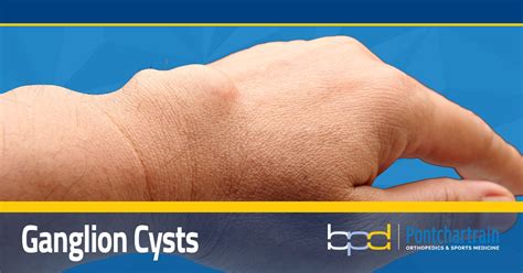 Ganglion Cysts Wrist Specialist Brandon P Donnelly Md