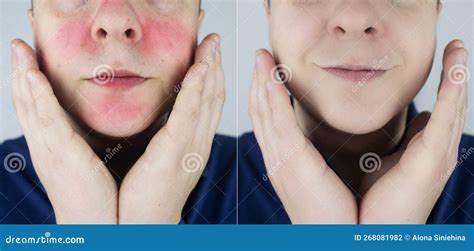 Rosacea Face The Man Suffers From Redness On Her Cheeks Couperose Of