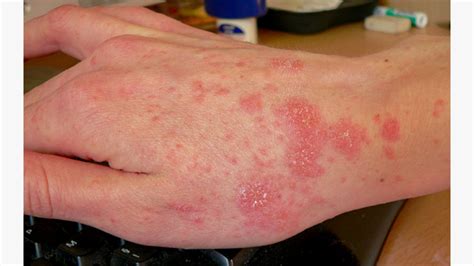 Skin Rashes Symptoms Causes Types Prevention Treatment