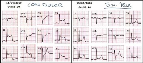 Infarto Agudo Al Miocardio Con Elevacion Del Segmento St Infarto Agudo Al Miocardio Con