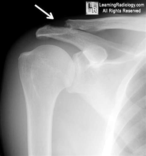 50k Shoulder Injury Learning Radiology Clavicle Clavicular