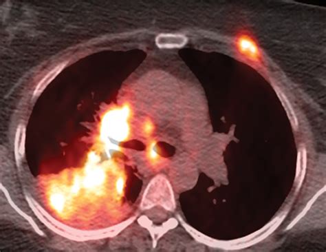 The Value Of Fdg Pet Ct In Treatment Response Assessment Follow Up And Surveillance Of Lung