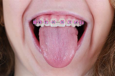 Woman With Open Mouth And Braces On Straight Teeth Showing Tongue Out