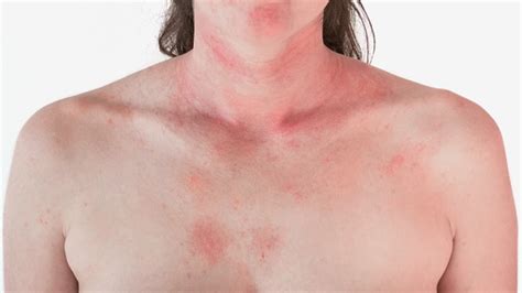 Allergic Skin Reaction On The Female Neck And Face Red Rash Stock Photo