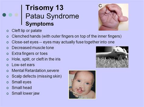Trisomy 13 Or Patau Syndrome Causes Symptoms Life Expectancy Treatment
