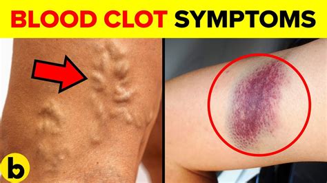 Blood Clot Symptoms 2 Symptoms Of A Blood Clot