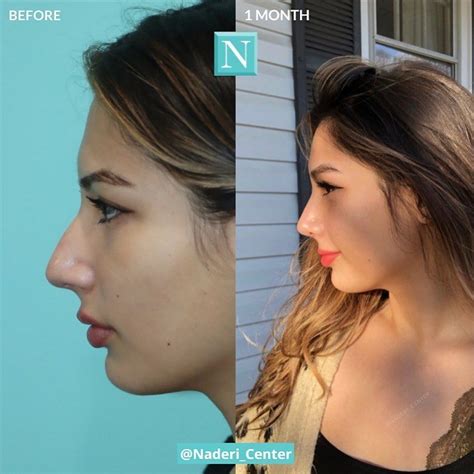 Post Rhinoplasty Selfie By Dr Naderis Patient Only Month Month Out From Rhinoplasty The