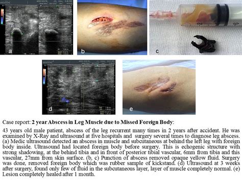 Vietnamese Medic Ultrasound Case 33602 Year Abscess In Leg Muscle Due