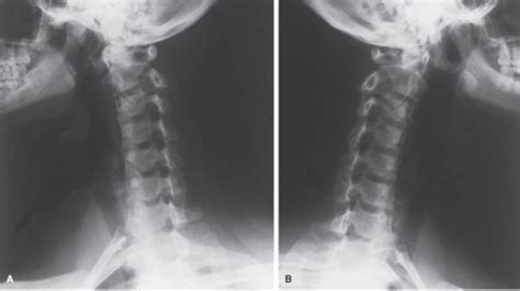 Right And Left Oblique C Spine Diagram Quizlet