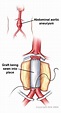 Open aortic surgery - Wikipedia