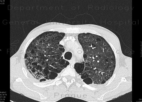 Radiology Case Bullous Emphysema