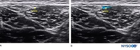 Ultrasound Guided Lateral Femoral Cutaneous Nerve Block Nysora