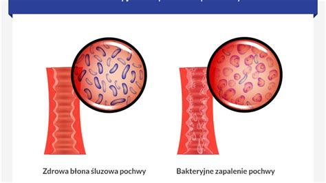 Bakteryjne Zapalenie Pochwy YouTube