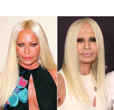 Donatella Versaces Shocking Plastic Surgery Makeover — Experts Speak