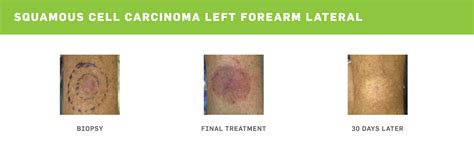 Squamous Cell Skin Cancer Treatment Options