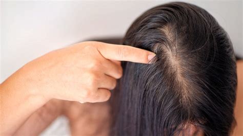 Actuar a tiempo la clave para frenar la caída del pelo en mujeres