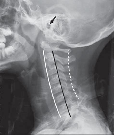 Radiograph Using Good Technique Shows Normal Lateral Cervical Spine In
