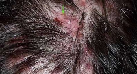 Scalp Folliculitis Hair