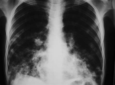 Typical Radiographic Finding Of Pulmonary Kaposis Sarcoma Diffuse