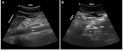 A Sagittal Sonogram Of The Empty Antrum With A Flat Appearance A
