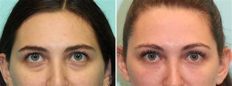 Tear Trough Under Eye Injections Photos Chevy Chase Md Patient
