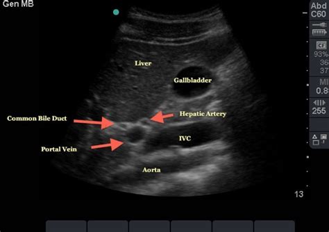 Common Bile Duct Ultrasound Images And Photos Finder