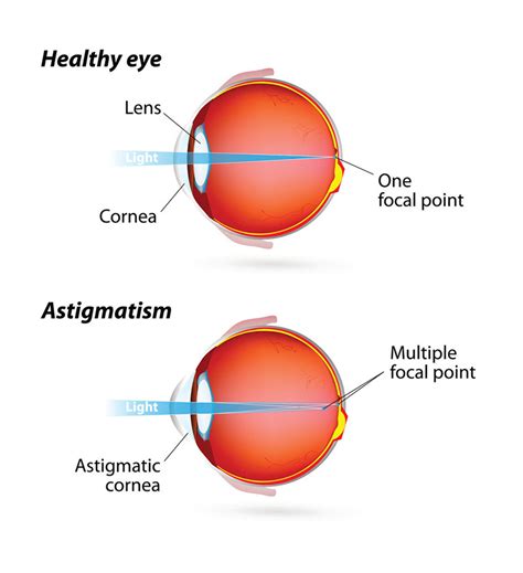 Understanding Astigmatism With Spindel Eye Associates