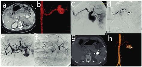 Images Of A 23 Year Old Woman With A Ruptured Splenic Artery Aneurysm