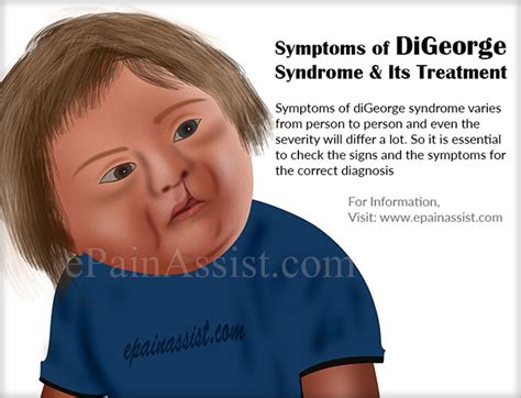 22q11.2 deletion syndrome — del 22q11.2 (22q11ds) may have more than 180 different physical, functional and mental associations that affect the patient's health and quality of life since very birth. Digeorge facial features - Adult archive