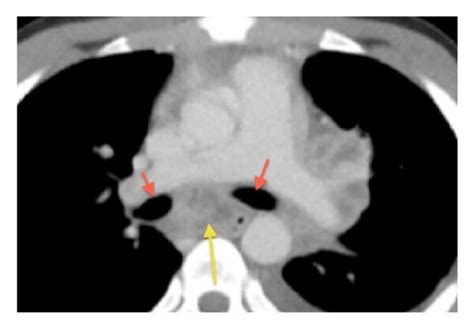 Compression Of Main Bronchi By Infracarinal Lymph Nodeabscesses