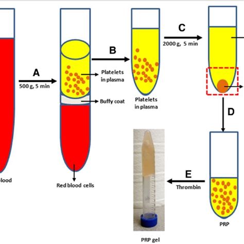 Preparation Of Platelet Rich Plasma Prp From The Whole Blood By Five