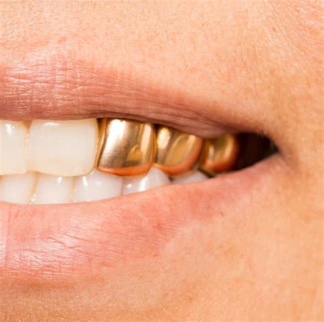 Permanent Gold Teeth History Cost Pros And Cons