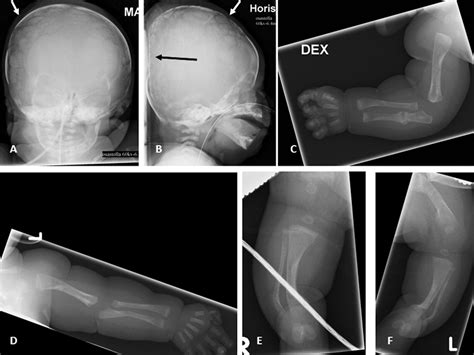 Severe Osteogenesis Imperfecta Type Iii And Its Challenging Treatment