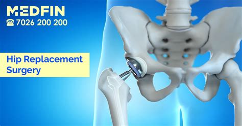 Hip Replacement Surgery Everything You Need To Know Medfin