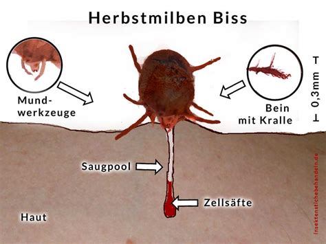 Grasmilben Beim Menschen Herbstgrasmilben Bisse Behandeln