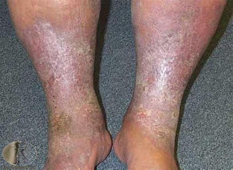 Derm Stasis Dermatitis And Leg Ulcers Flashcards Quizlet