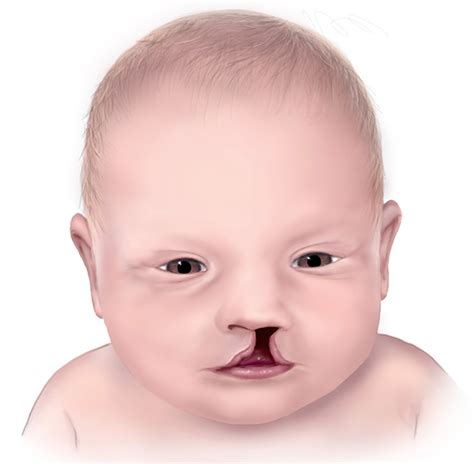 Cleft Palate And Cleft Lip Causes Symptoms Repair Surgery