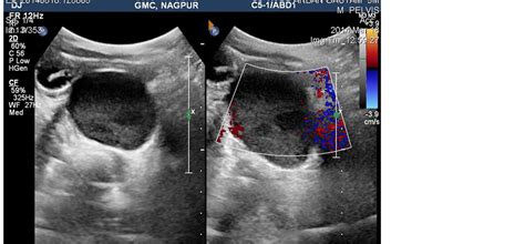 Anterior Rectal Duplication Cyst A Rare Case Report