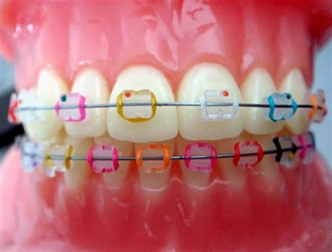 Showing The Different Color Options Paired With Ceramic Brackets