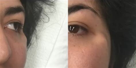 Watch Dr Pimple Popper Remove A Huge Cyst Right Next To A Womans Eye