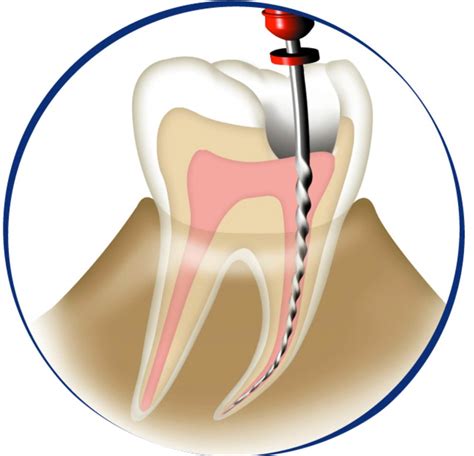 What Is Dental Glide Path News Dentagama