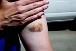 Unexplained Bruising: Causes, Treatment, and Prevention