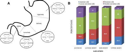 Distribution Of Early Gastric Cancer A Location Of Early Gastric