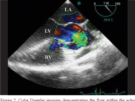 Figure 2 From Perivalvular Abscess Of Tricuspid Valve A Rare