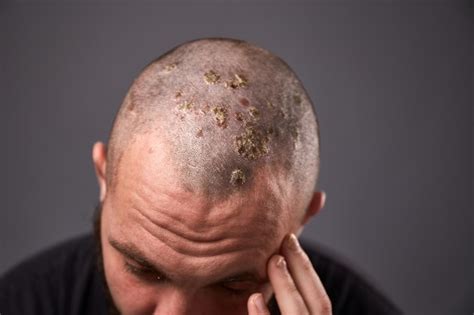 Premium Photo Man With Dry Flaky Skin On His Head With Psoriasis And
