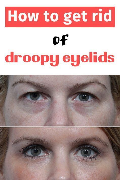 How To Get Rid Of Droopy Eyelids Glamour N Health Droopy Eyelids