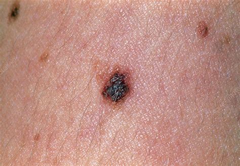 Benign Melanocytic Naevus Mole On The Skin Stock Image M2200097