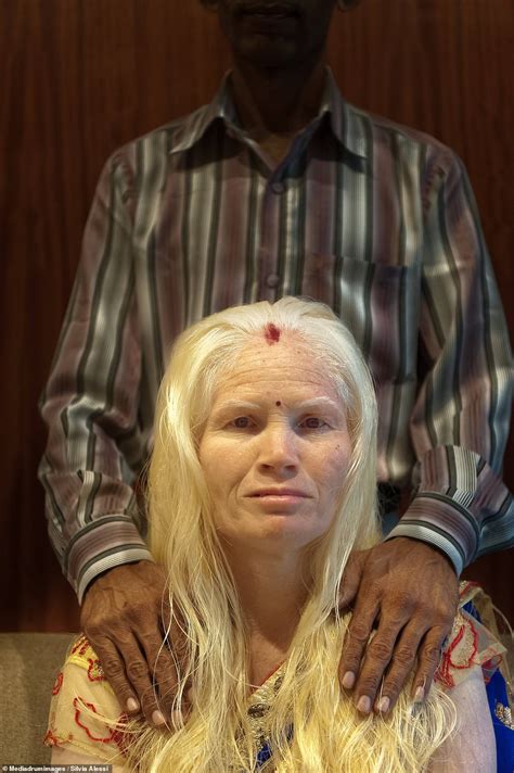 Photographer Captures Beauty Of Albino Skin In People Across The Globe