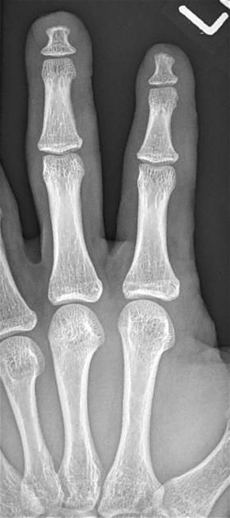 Acro Osteolysis Radiology Case Radiology