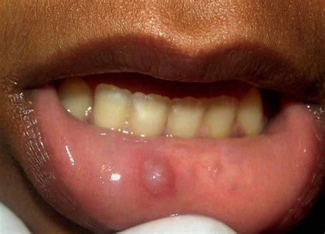 Pictures Causes Symptoms Treatment Of Oral Mucocele Hubpages